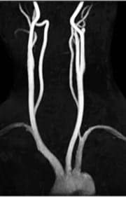 大動脈弓部～頸部血管
